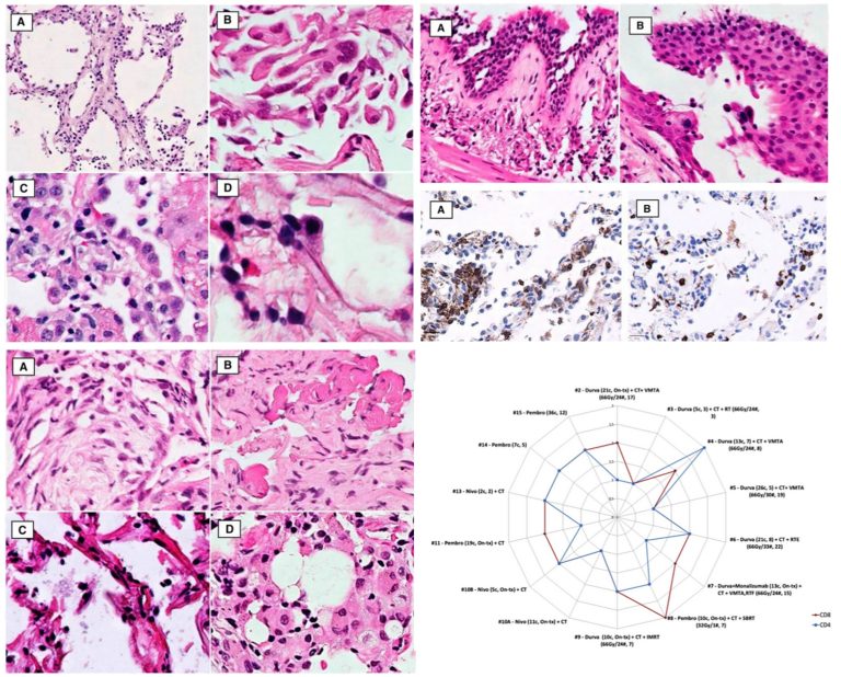Clinical and histopathological features of immune checkpoint inhibitor-induced lung toxicity