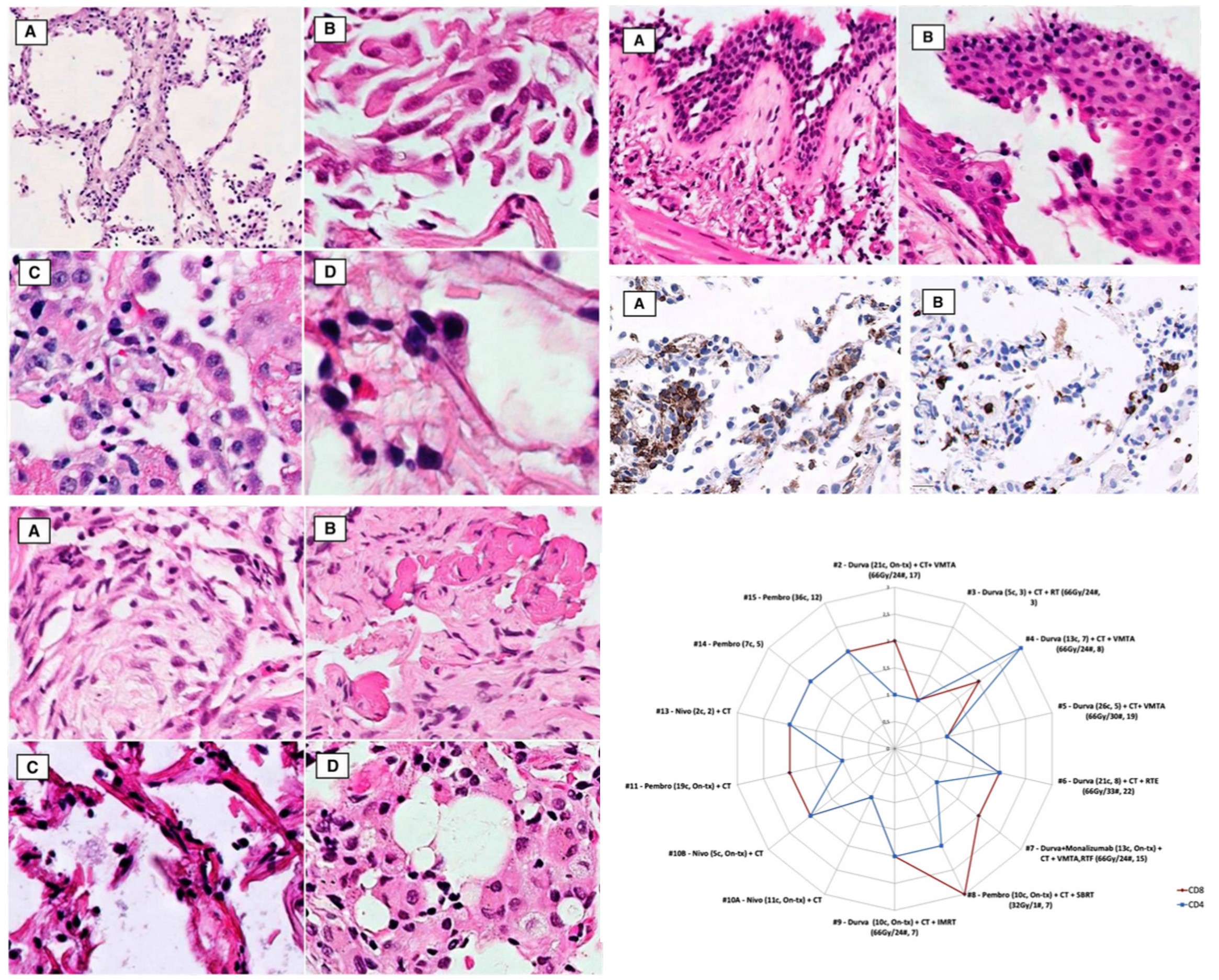 Clinical and histopathological features of immune checkpoint inhibitor-induced lung toxicity