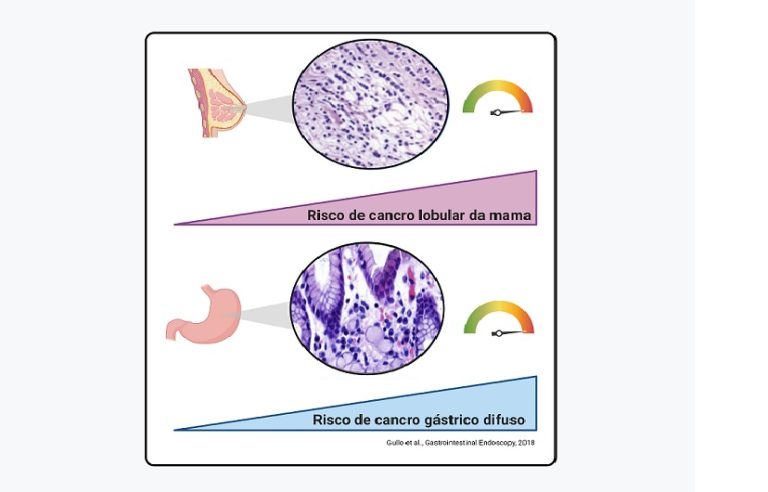 Estudo clarifica mutações de risco para desenvolvimento de Cancro Gástrico Difuso Hereditário