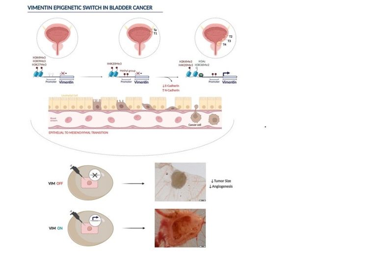 Revelada nova relação entre mecanismos epigenéticos e o desenvolvimento de cancro da bexiga